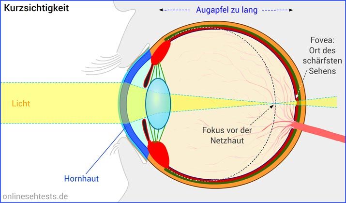 Kurzsichtigkeit