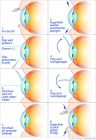 Augen Lasern