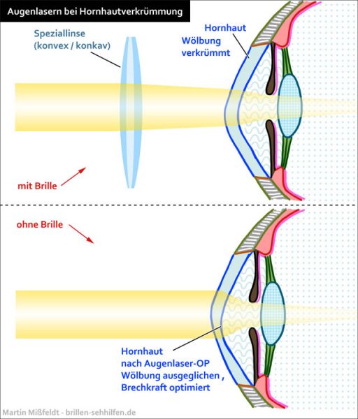 Augenlasern bei Hornhautverkrümmung Augenlasern bei Hornhautverkrümmung