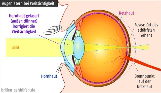 Augenlasern bei Weitsichtigkeit