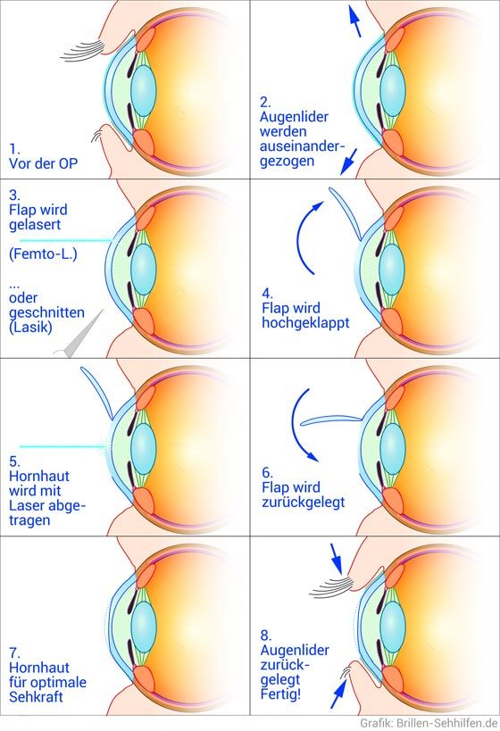 Augenlasern