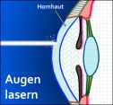 Kosten Augenlasern