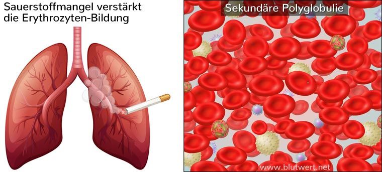 Erhöhte Erythrozyten