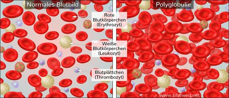 Erythrozyten Erhöht