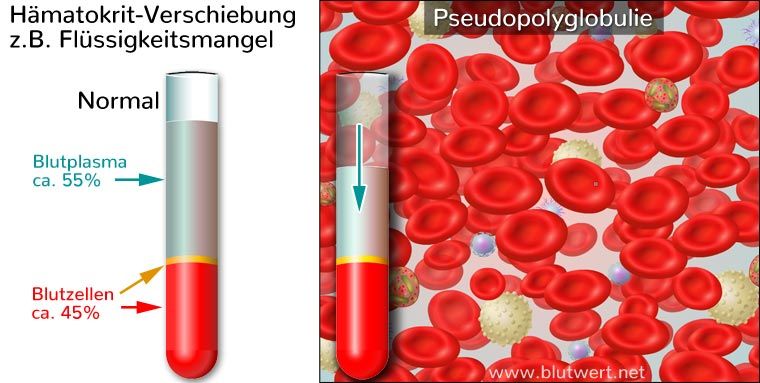 Pseudopolyglobulie