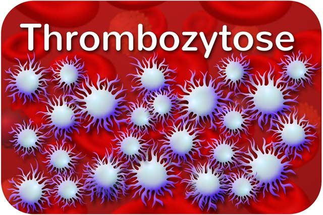 Thrombozytose