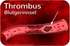 Thrombus