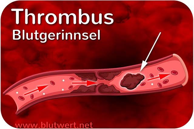 Thrombus