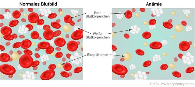 Was ist Blutarmut?