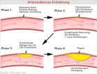Arteriosklerose