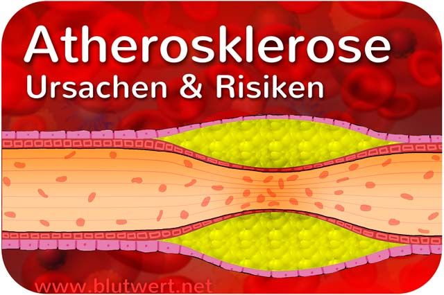 Atherosklerose