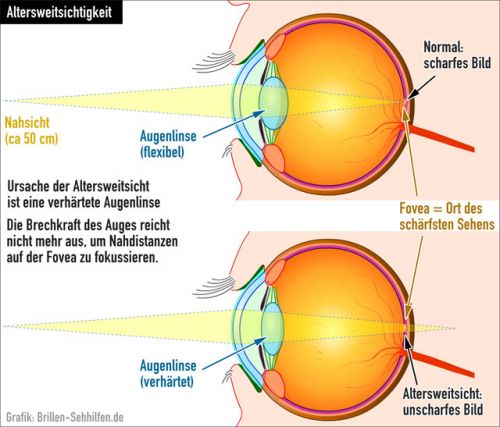 Altersweitsicht