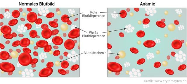Anämie Symptome