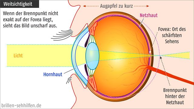 übersichtigkeit